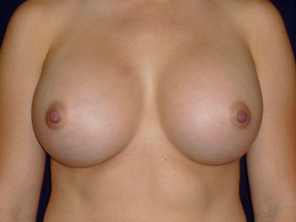 after breast augmentation revision front view female patient case 3308