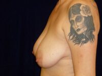 before breast augmentation with lift left side view female patient case 3297