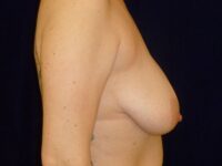 before breast augmentation with lift right side view female patient case 3297