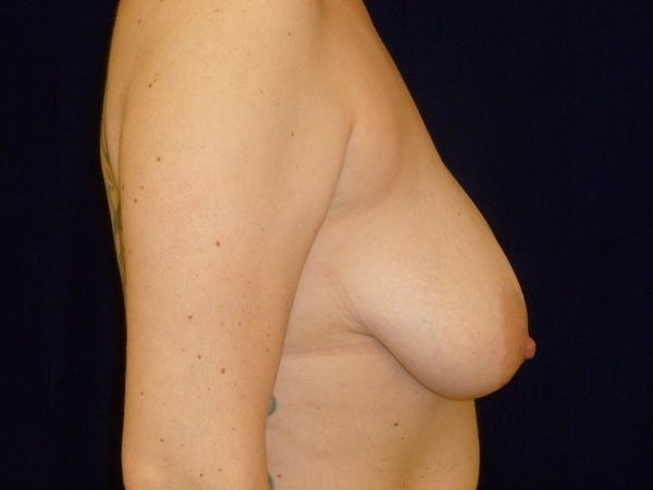 before breast augmentation with lift right side view female patient case 3297