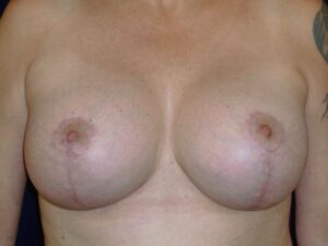 after breast augmentation with lift front view female patient case 3297