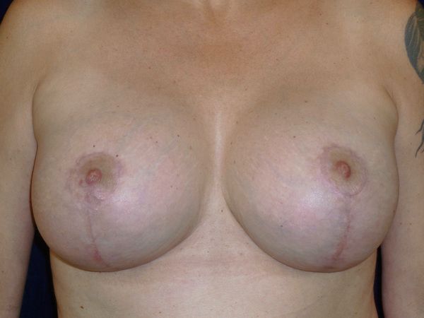 after breast augmentation with lift front view female patient case 3297