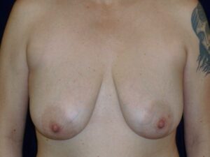 before breast augmentation with lift front view female patient case 3297