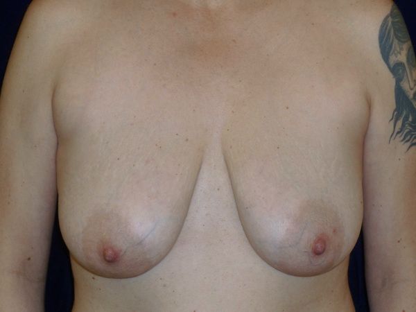 before breast augmentation with lift front view female patient case 3297