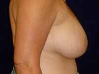 before breast lift right side view female patient case 3374