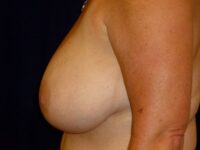 before breast lift left side view female patient case 3374