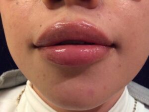 after dermal fillers front view female patient case 3200