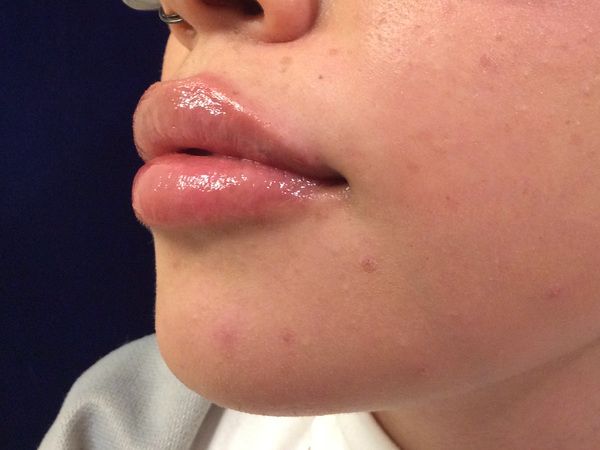 after dermal fillers left angle view female patient case 3200