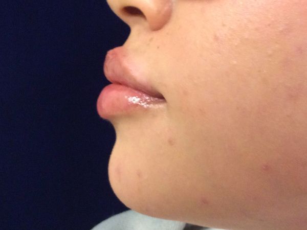 after dermal fillers left side view female patient case 3200