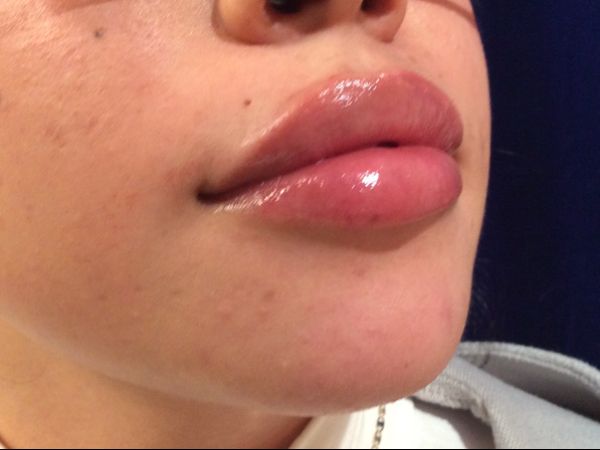 after dermal fillers right angle view female patient case 3200