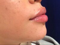after dermal fillers right side view female patient case 3200