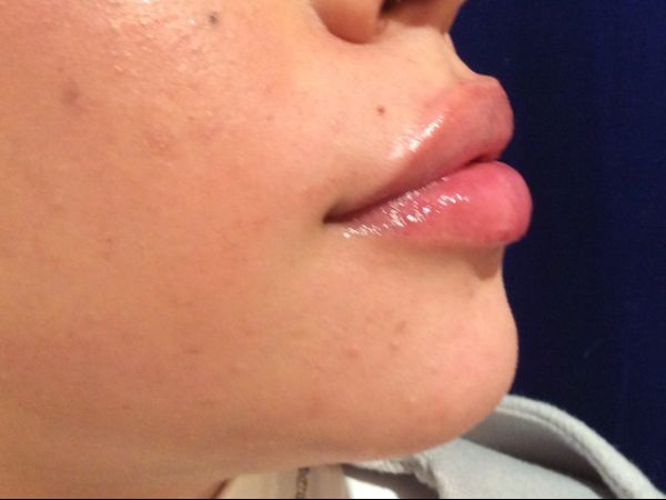 after dermal fillers right side view female patient case 3200