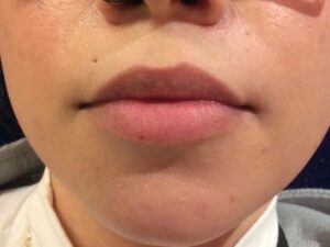 before dermal fillers front view female patient case 3200