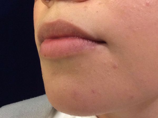 before dermal fillers left angle view female patient case 3200