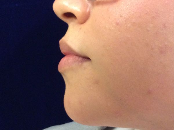 before dermal fillers left side view female patient case 3200