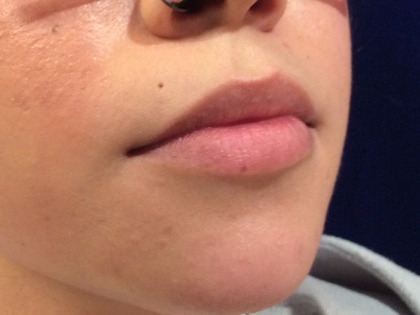 before dermal fillers right angle view female patient case 3200