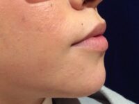 before dermal fillers right side view female patient case 3200