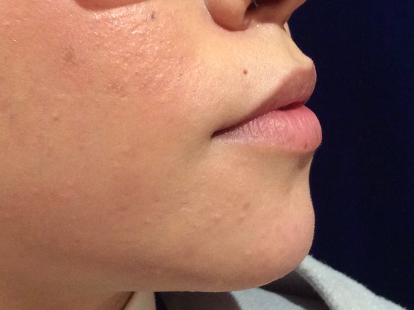 before dermal fillers right side view female patient case 3200