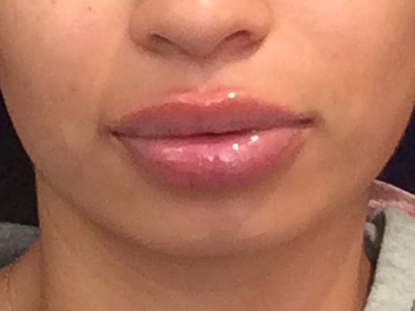 after dermal fillers front view female patient case 3211