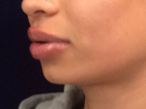 after dermal fillers left angle view female patient case 3211