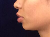 after dermal fillers left side view female patient case 3211