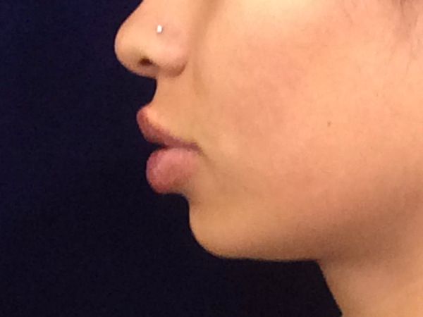 after dermal fillers left side view female patient case 3211