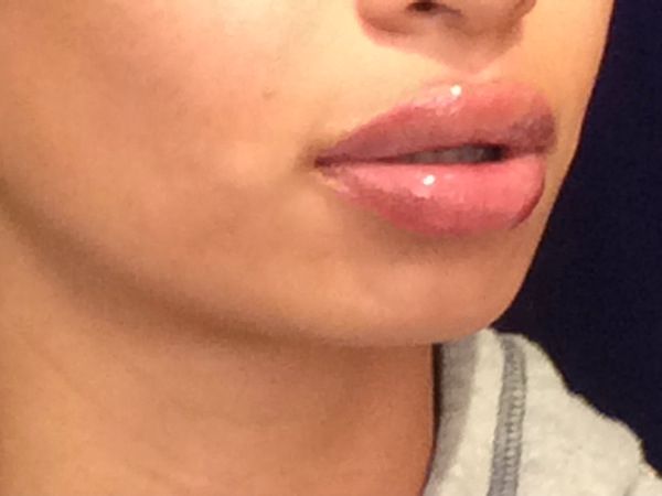 after dermal fillers right angle view female patient case 3211