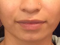before dermal fillers front view female patient case 3211