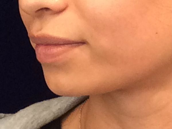 before dermal fillers left angle view female patient case 3211