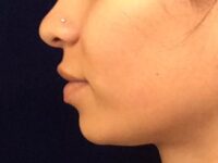 before dermal fillers left side view female patient case 3211