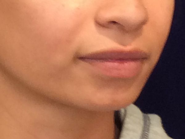 before dermal fillers right angle view female patient case 3211
