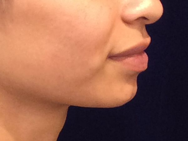before dermal fillers right side view female patient case 3211