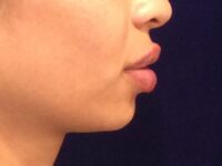 after dermal fillers right side view female patient case 3211