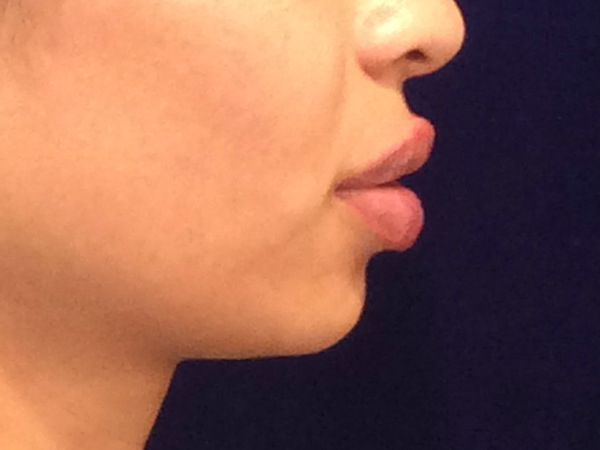 after dermal fillers right side view female patient case 3211