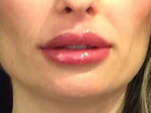 after dermal filler front view female patient case 3222