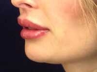 after dermal filler left angle view female patient case 3222