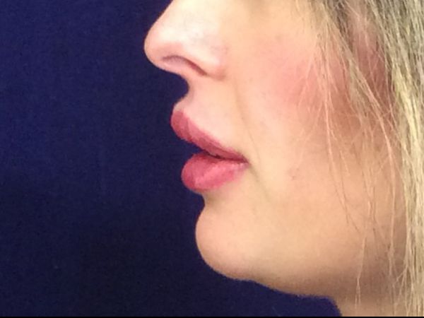 after dermal filler left side view female patient case 3222