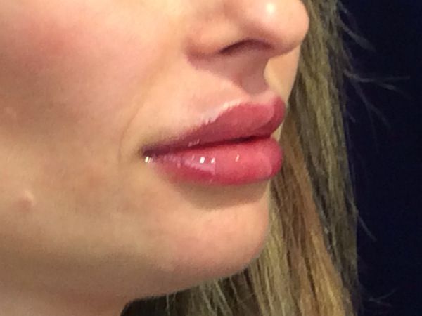 after dermal filler right angle view female patient case 3222