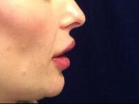 after dermal filler right side view female patient case 3222