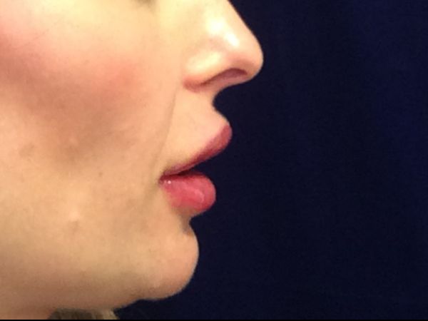 after dermal filler right side view female patient case 3222
