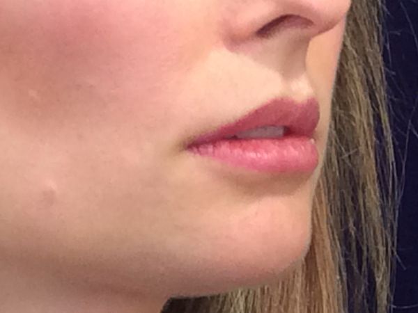 before dermal filler right angle view female patient case 3222