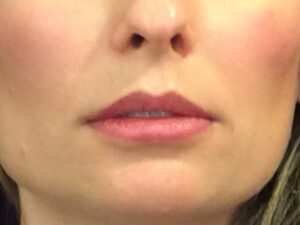 before dermal filler front view female patient case 3222