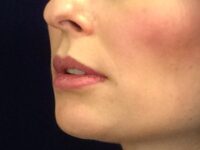 before dermal filler left angle view female patient case 3222