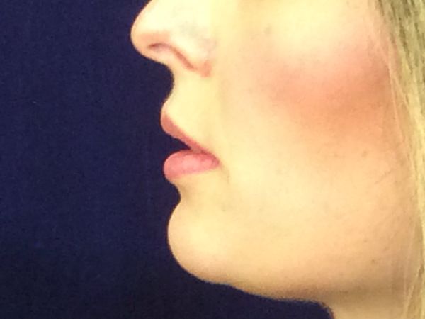 before dermal filler left side view female patient case 3222