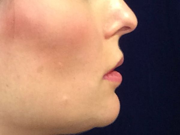 before dermal filler right side view female patient case 3222