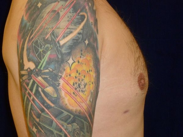 after gynecomastia right side view male patient case 3265