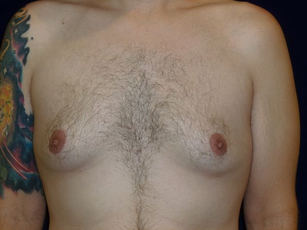 before gynecomastia front view male patient case 3265