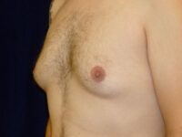 before gynecomastia left angle view male patient case 3265