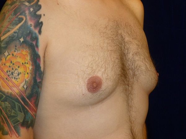 before gynecomastia right angle view male patient case 3265