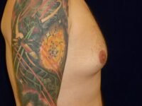 before gynecomastia right side view male patient case 3265